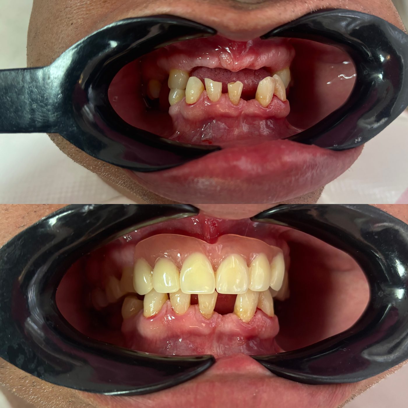 Antes y después de una rehabilitación: arriba faltan dientes superiores; abajo, la sonrisa completa con su prótesis