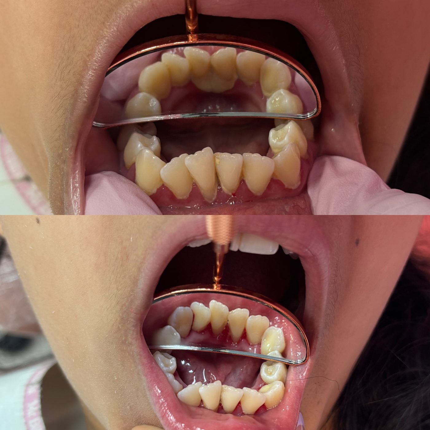 Antes y después de una limpieza: dientes inferiores vistos en el espejo dental
