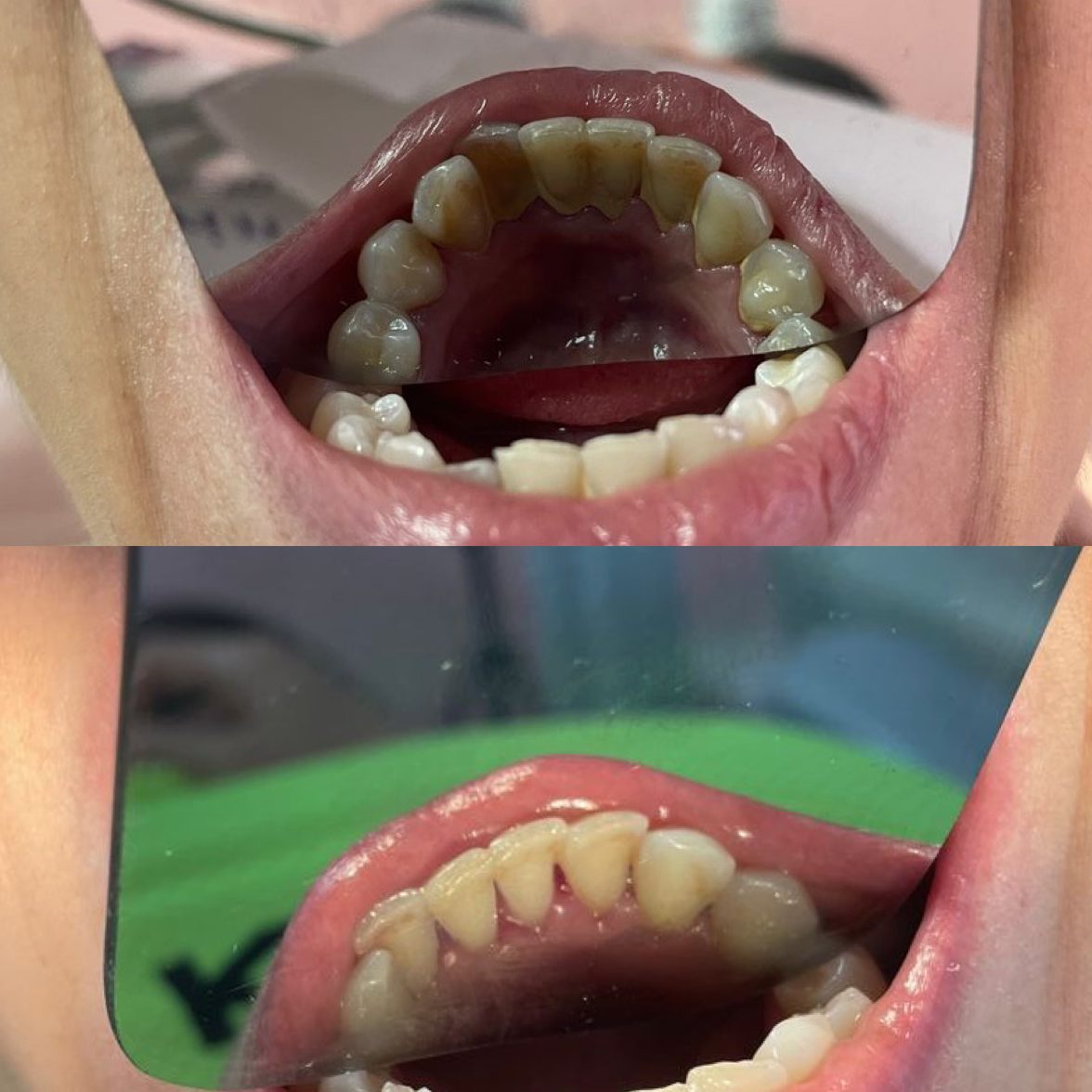 Antes y después de una limpieza: dientes inferiores con manchas y sarro, y luego limpios
