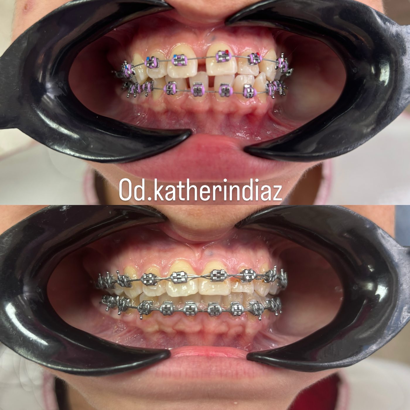 Paciente con brackets metálicos y ligas lilas: dientes con espacios al inicio y alineados después