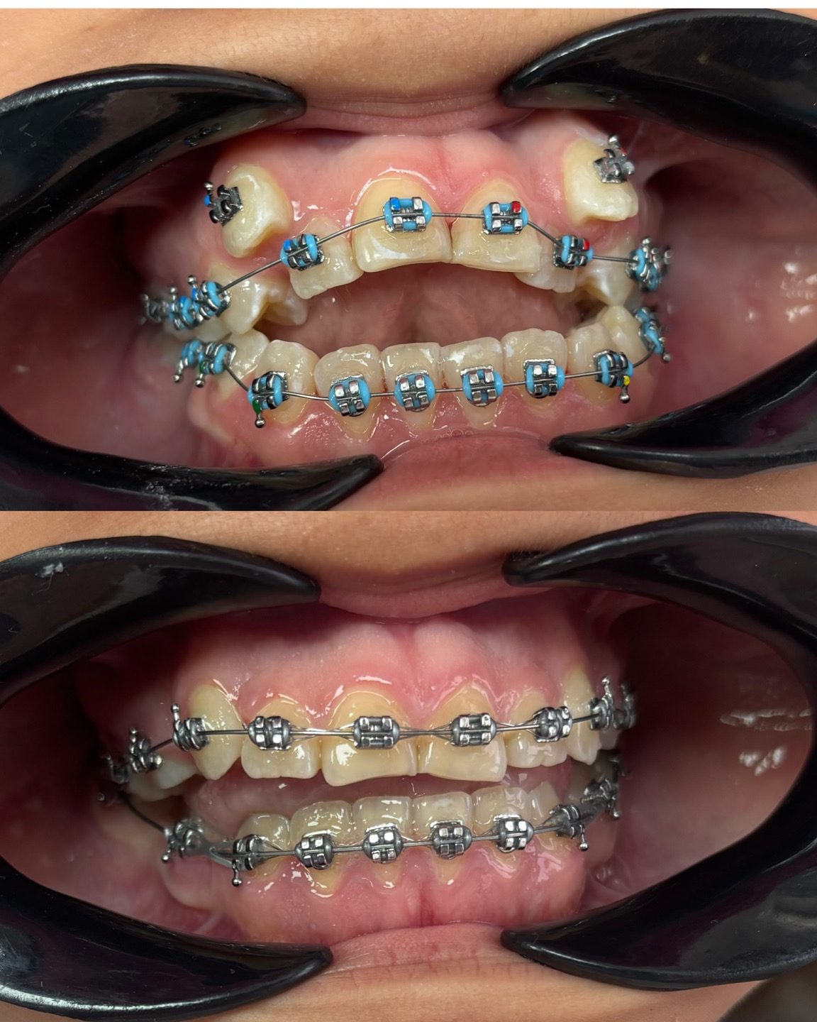 Paciente con brackets y ligas azules: dientes apiñados al inicio y alineados más adelante en el tratamiento