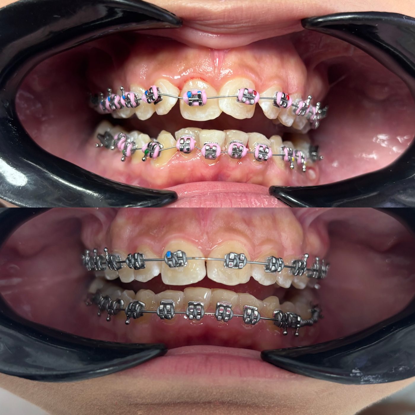 Paciente con brackets metálicos y ligas rosadas, antes y durante la alineación