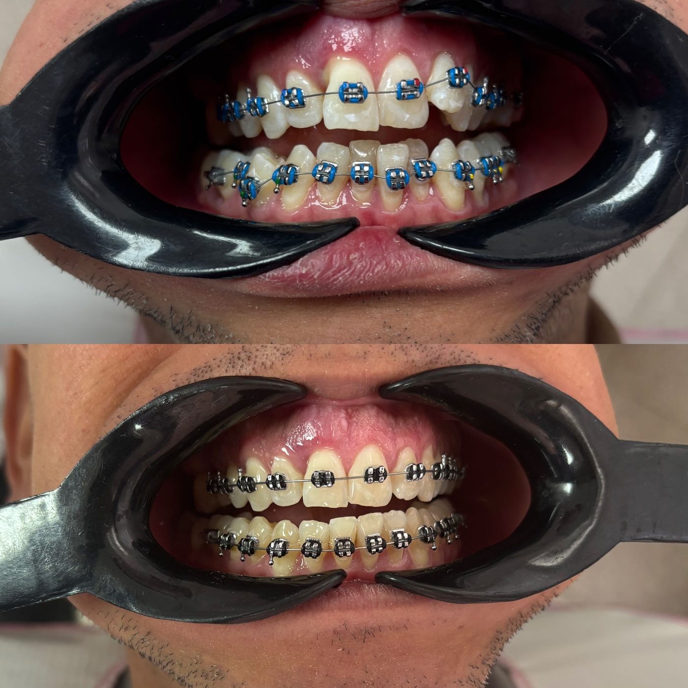 Paciente con brackets y ligas azules, y luego con ligas grises con los dientes más alineados