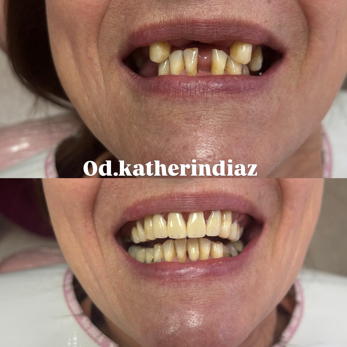 Antes y después de una rehabilitación: arriba faltan dientes; abajo, la sonrisa completa