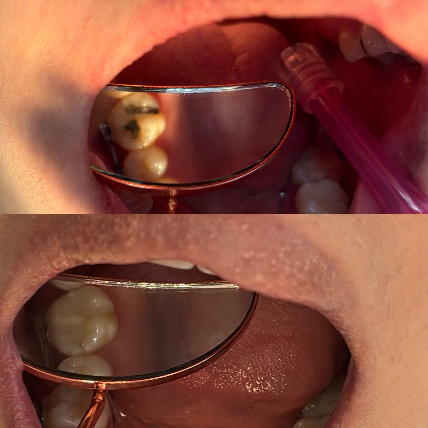 Antes y después vistos en el espejo dental: una muela con empaste oscuro y luego restaurada del color del diente